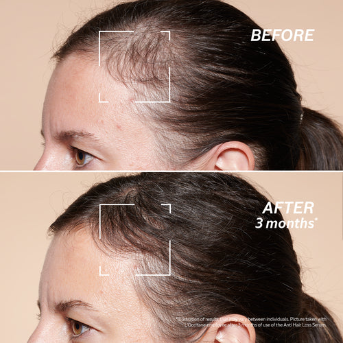 Anti-Hair Loss Treatment - Image 4
